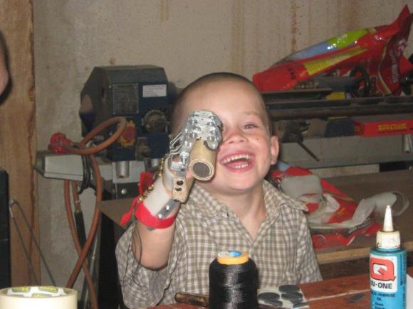 Liam's prosthetic hand.