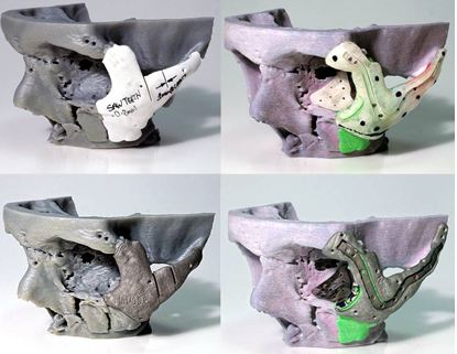 Facial Reconstruction