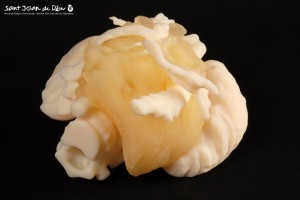 3d-model-tumour-surrounded-by-blood-vessels-arteries
