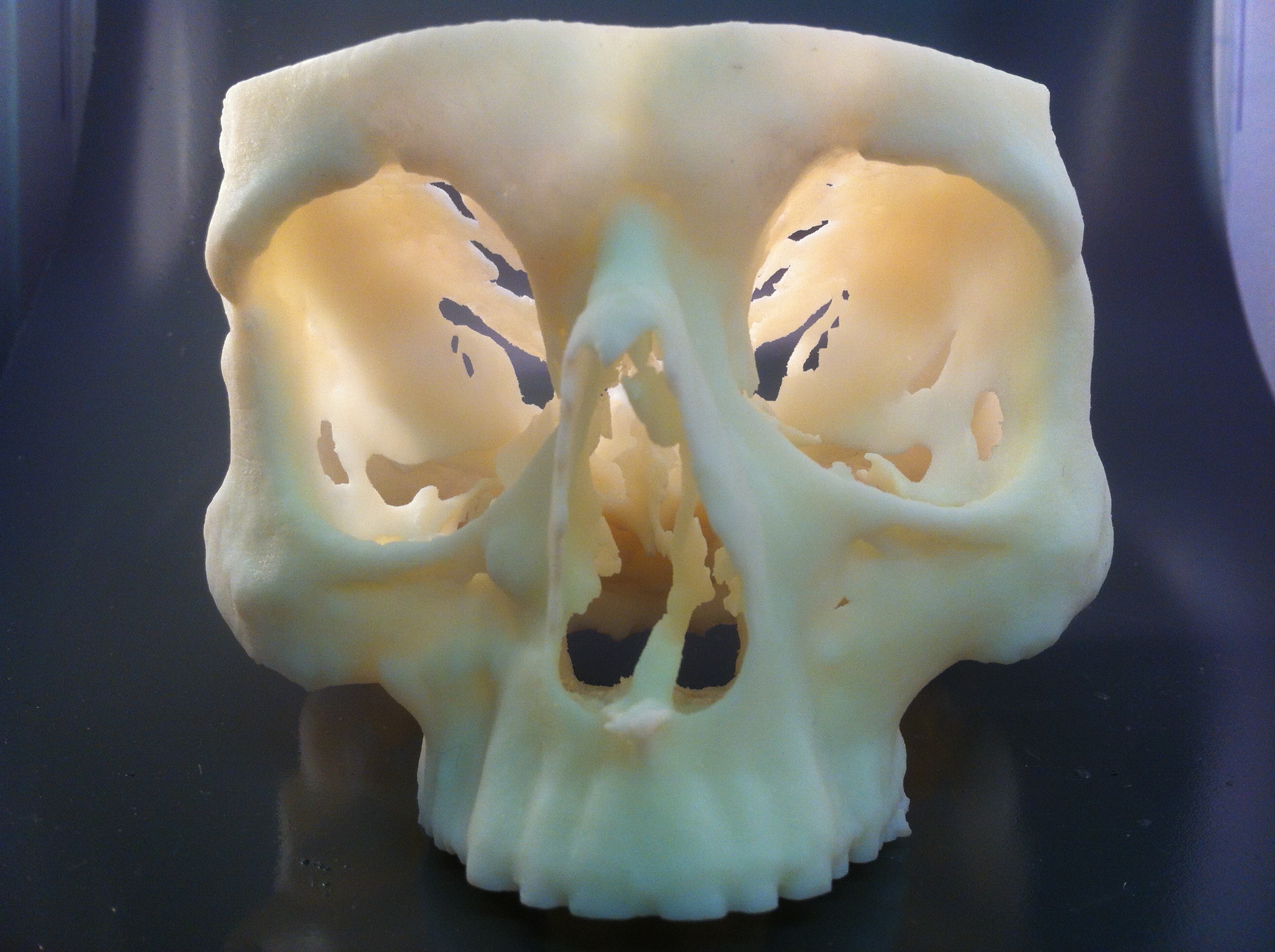 This skull was built on a Stratasys Objet 30 Pro, and was used to validate patient surgery prior to operation. Courtesy of Stratasys.