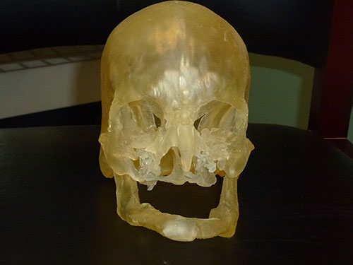 A model like this can guide surgeons during a face transplant procedure. Image: Brigham and Women's Hospital