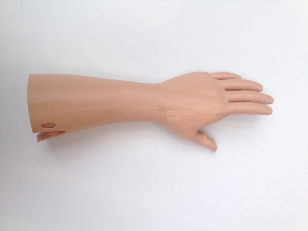 The LifeArm prosthetic from 3DLifePrints, customized from client scan-data. (Image courtesy 3D LifePrints)