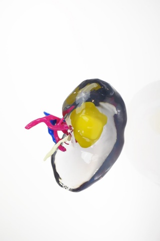 NYU School of Medicine leverages the Stratasys J750 to build multi-colored, 3D printed kidney cancer models. Image courtesy of Business Wire.