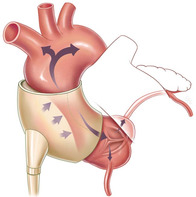 Abaqus FEA Leads to Lifesaving Heart Pump