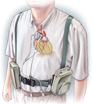 Abaqus FEA Leads to Lifesaving Heart Pump