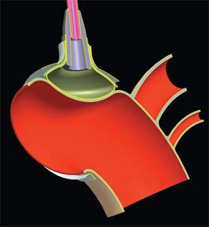 Abaqus FEA Leads to Lifesaving Heart Pump