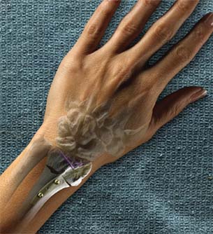 Driving competitive Advantage Through PLM at Wright Medical Technology Inc.