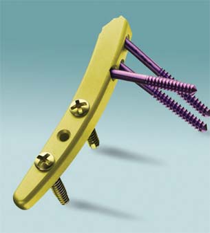 Driving competitive Advantage Through PLM at Wright Medical Technology Inc.