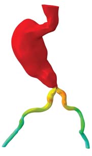 Medical Applications Tap Power of CFD