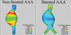 Seeing Inside an Aneurysm Using EnSight
