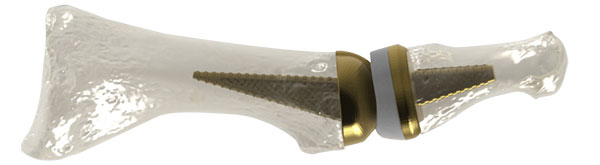 AddUp and Anatomic Implants Collaborate on 3D Printed Joint Replacement