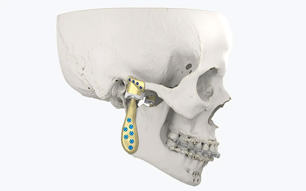 Materialise Launches a Personalized TMJ Total Arthroplasty System