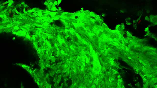 3D Printing to Lead Fight Against Brain Tumors